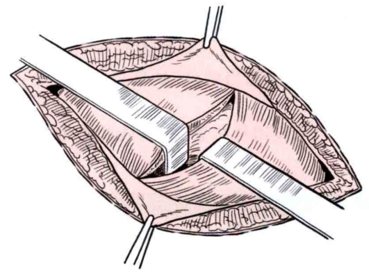 手术百科 普外科 结,直肠,肛门手术 阑尾切除术  1.