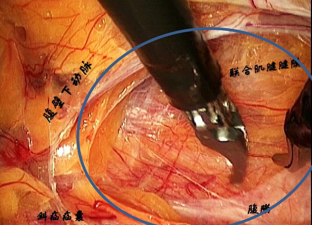 腹腔镜全腹膜外腹股沟疝修补术(tep)