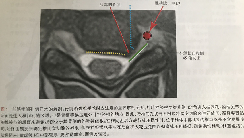 (行钩突骨赘切除术时,必须牢记神经根从腹外侧方与轴面大约成45°角