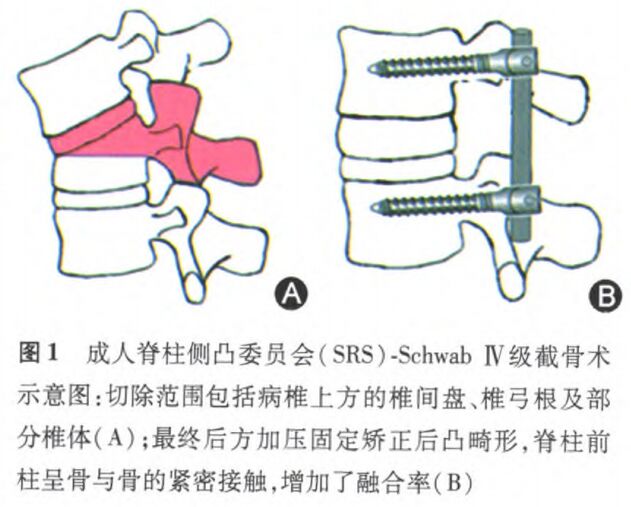 手术采用全身麻醉,患者取俯卧位,暴露以伤椎为中心的目标固定节段,在