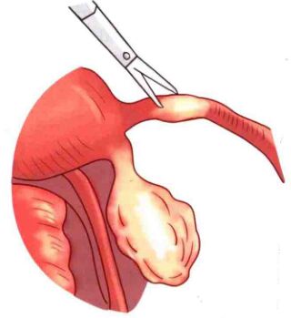 开腹输卵管结扎术高清图片