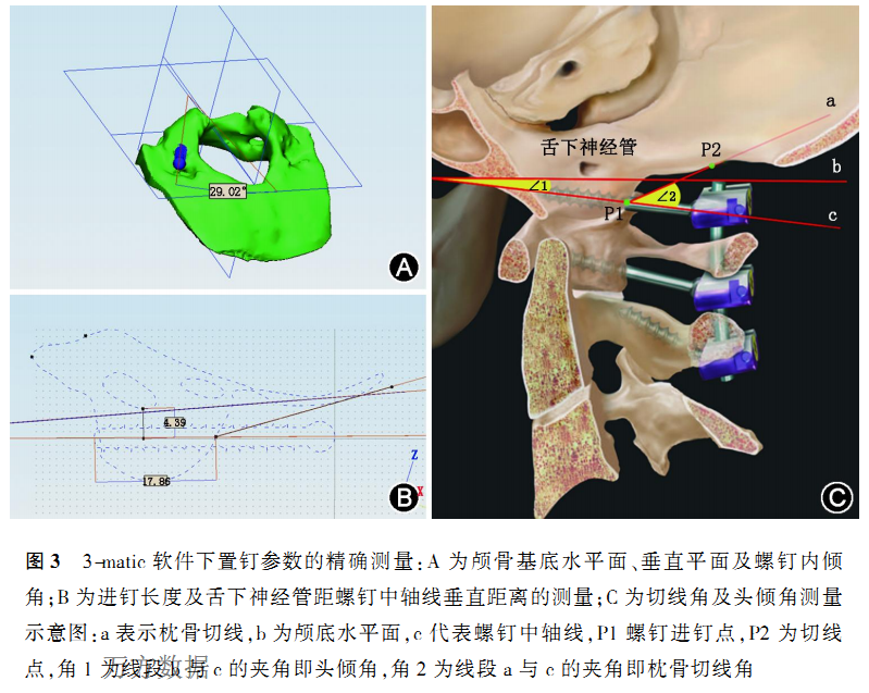 枕骨髁突后切迹,枕骨突出,髁突骨折_大山谷图库