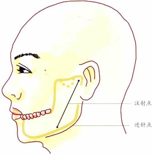   下牙槽神经阻滞麻醉