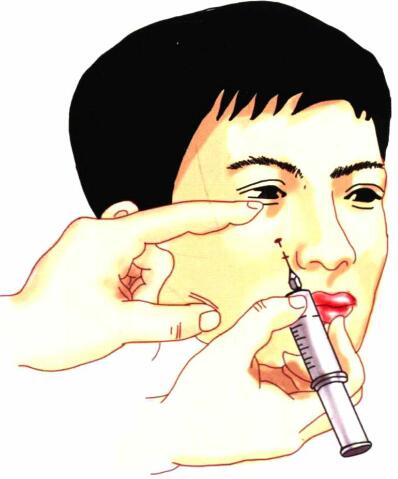    眶下神经阻滞麻醉.
